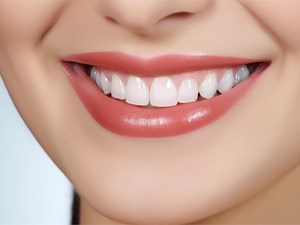 Carillas: qué son y por qué están de moda