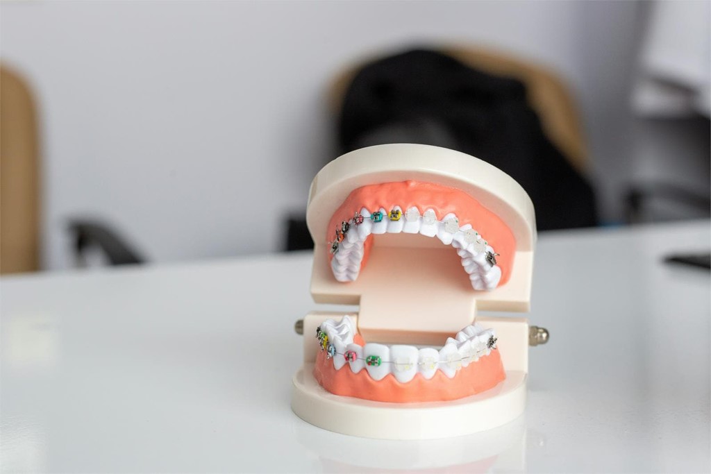 ¿Demasiado pronto para poner brackets?