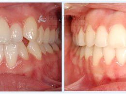 H-frontal-1-scaled