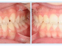 H-frontal-3-670x300