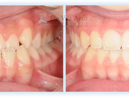 H-frontal-3-scaled
