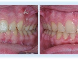 H-frontal-4-670x300