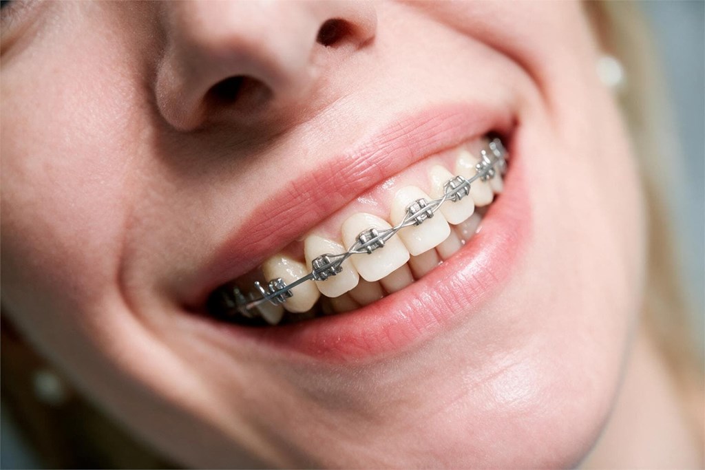Higiene con brackets: 4 herramientas clave para un cepillado perfecto