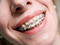 Higiene con brackets: 4 herramientas clave para un cepillado perfecto