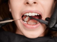 La importancia de las revisiones dentales regulares: prevención y detección temprana